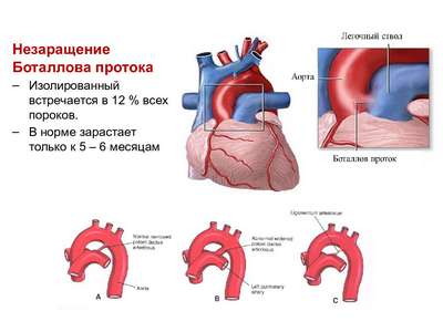 Незаращение боталлова протока сердца (Врожденные патологии сердца)