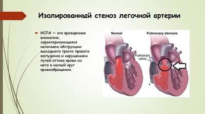 Стеноз отверстия легочной артерии (Врожденные патологии сердца)