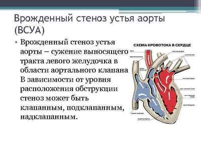 Стеноз устья аорты (Врожденные патологии сердца)