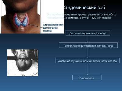Гиперплазия щитовидной железы (гипотиреодизм)