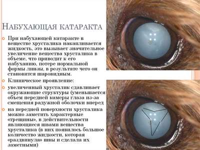 Диплостоматоз (Катаpaкта глаза)