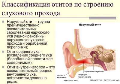 Воспаление среднего и внутреннего уха (Отит)