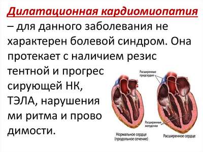 Дилатационная кардиомиопатия (ДКМП)