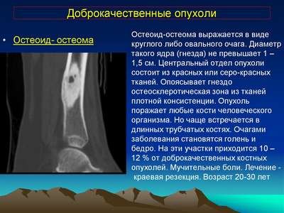 Опухоль костей (Остеома)