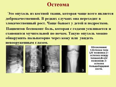 Остеома (опухоль костей)